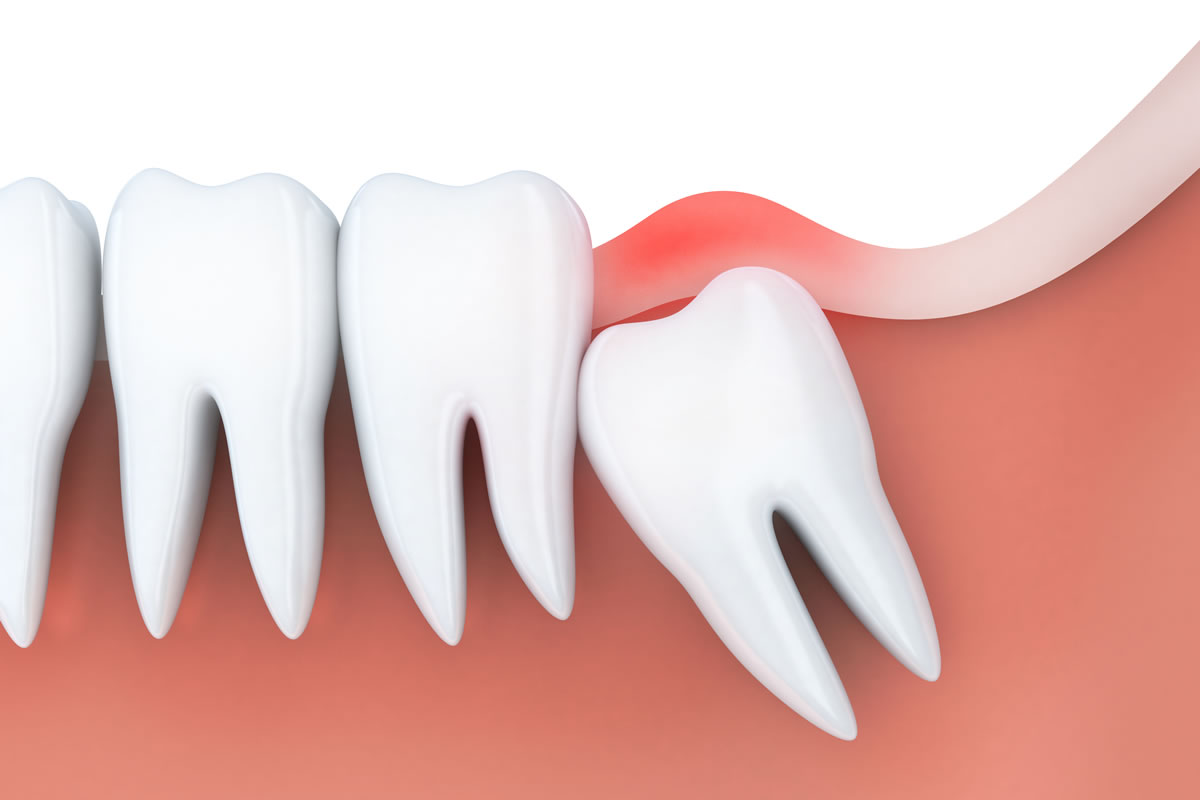 Finding a Dentist Near Me: Dealing with Pain After Root Canal